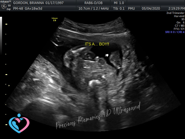 Pregnancy Ultrasound Image Gallery 17 24 Weeks