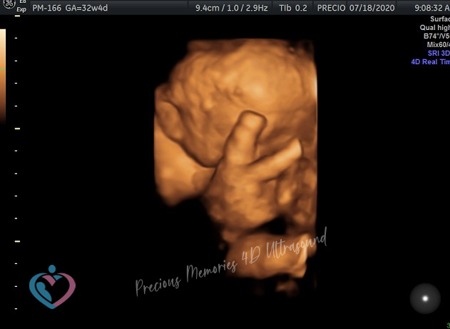 Pregnancy Ultrasound Image Gallery - 25 - 32 Weeks