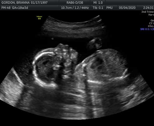 2D Pregnancy Ultrasounds