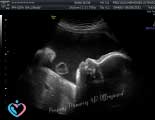 2D Pregnancy Ultrasounds in Astacocita TX