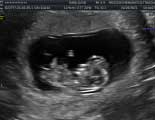 2D Pregnancy Ultrasounds in Humble TX