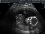 2D Pregnancy Ultrasound Images