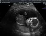 2D Pregnancy Ultrasound Images