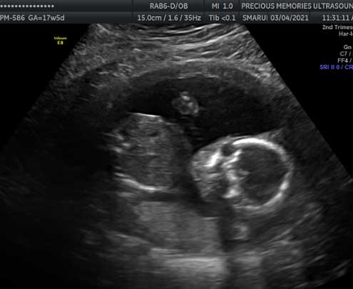 2D Pregnancy Ultrasounds in Spring Texas