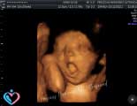 3D Pregnancy Ultrasound in Atascocita TX
