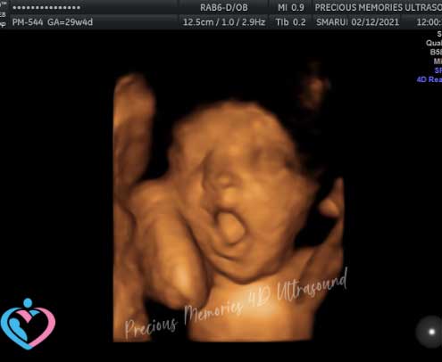 3D Pregnancy Ultrasounds