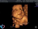 3D Pregnancy Ultrasound in Humble TX