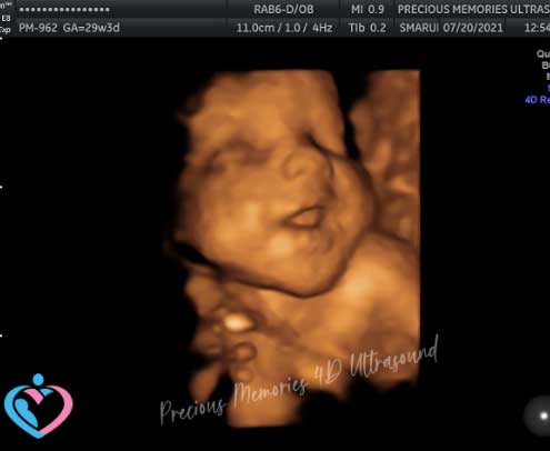 Pregnancy Ultrasound Imaging