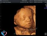 3D Pregnancy Ultrasound Images