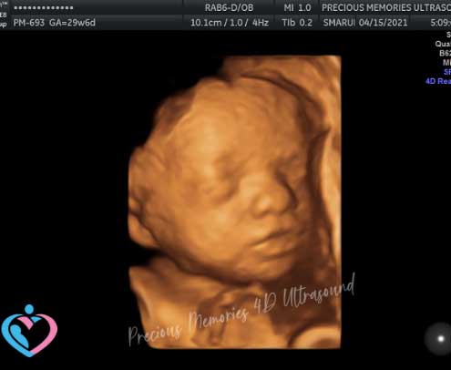 3D Pregnancy Ultrasound Images