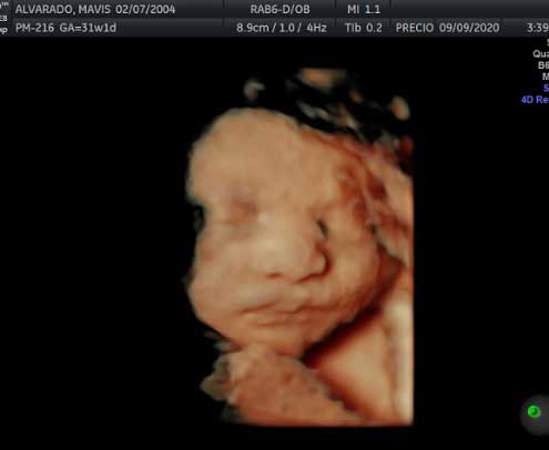 Pregnancy Ultrasound Images