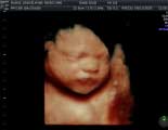 Pregnancy Ultrasounds