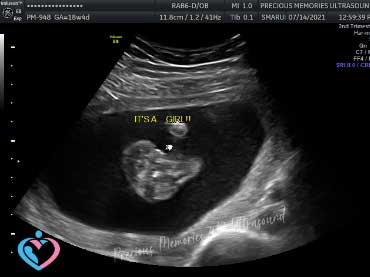 Atascocita Pregnancy Ultrasound