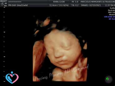Pregnancy Ultrasound Sound